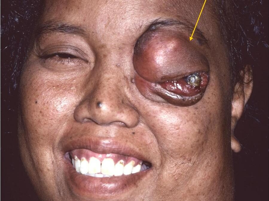 Neurofibromatosis 1:  Von Recklinghausen’s Disease…