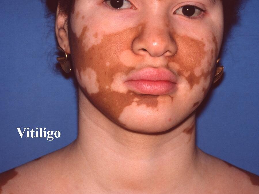 Vitiligo:  Leukoderma, Sins Against the Sun…
