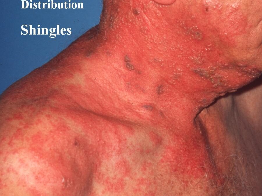 Shingles:  The Varicella-Zoster Connection…