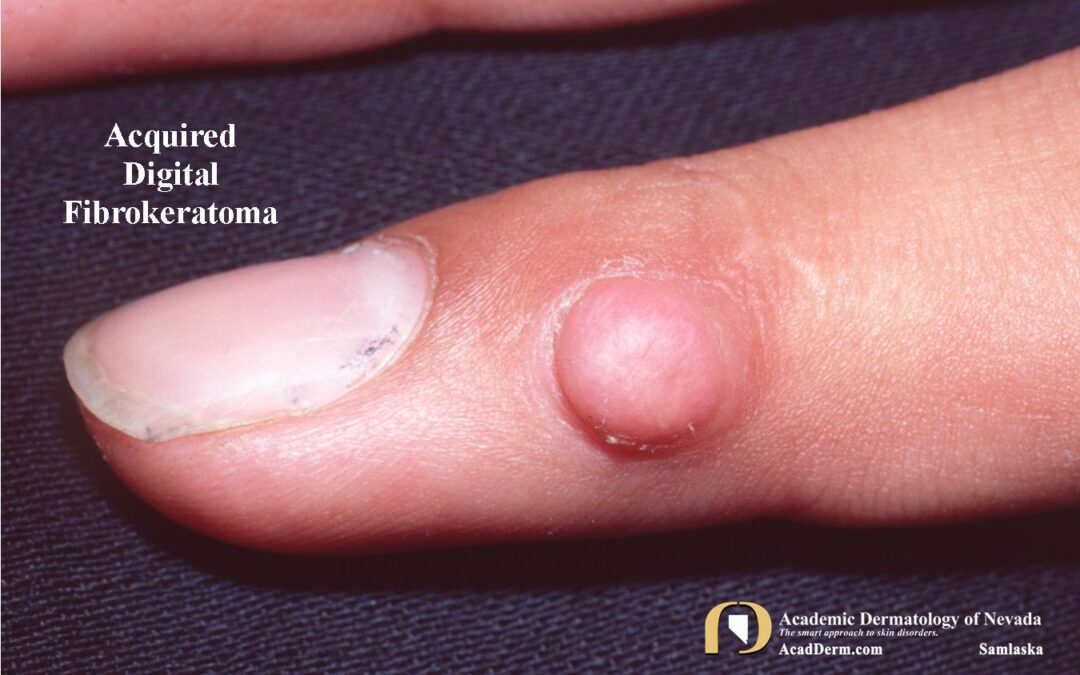 Acquired Digital Fibrokeratoma (ADFK):  Acral Fibrokeratoma…
