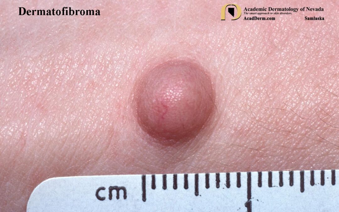 Dermatofibroma:  Benign Fibrous Histiocytoma…