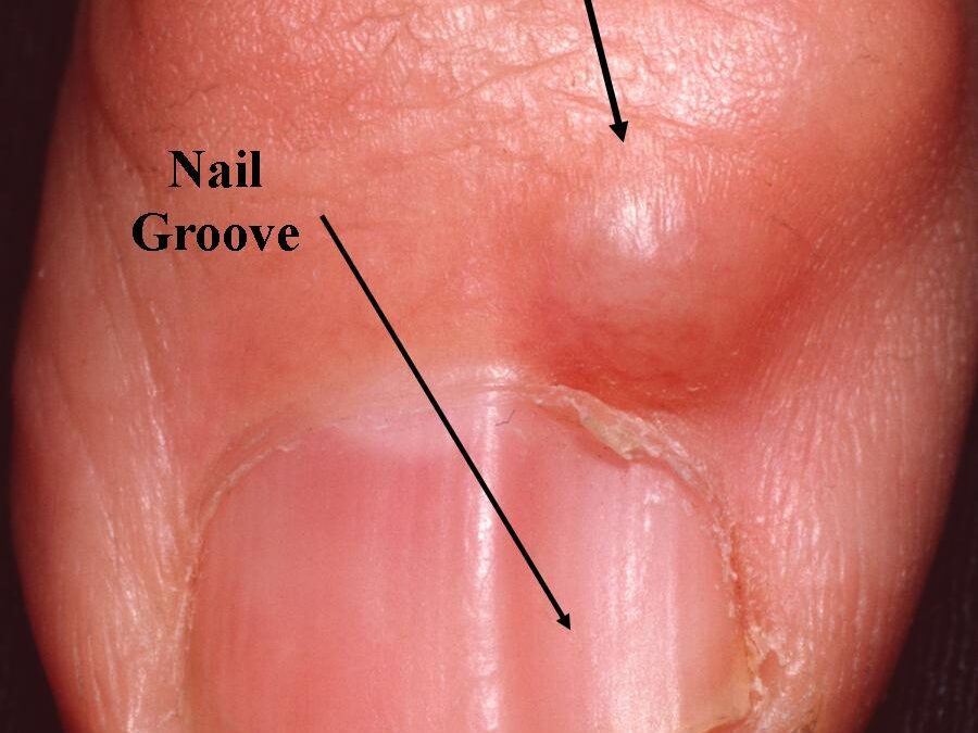 Digital Mucous Cyst (DMC):  Myxoid Cyst…