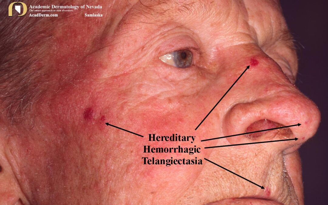 Hereditary Hemorrhagic Telangiectasia:  Osler-Weber-Rendu…