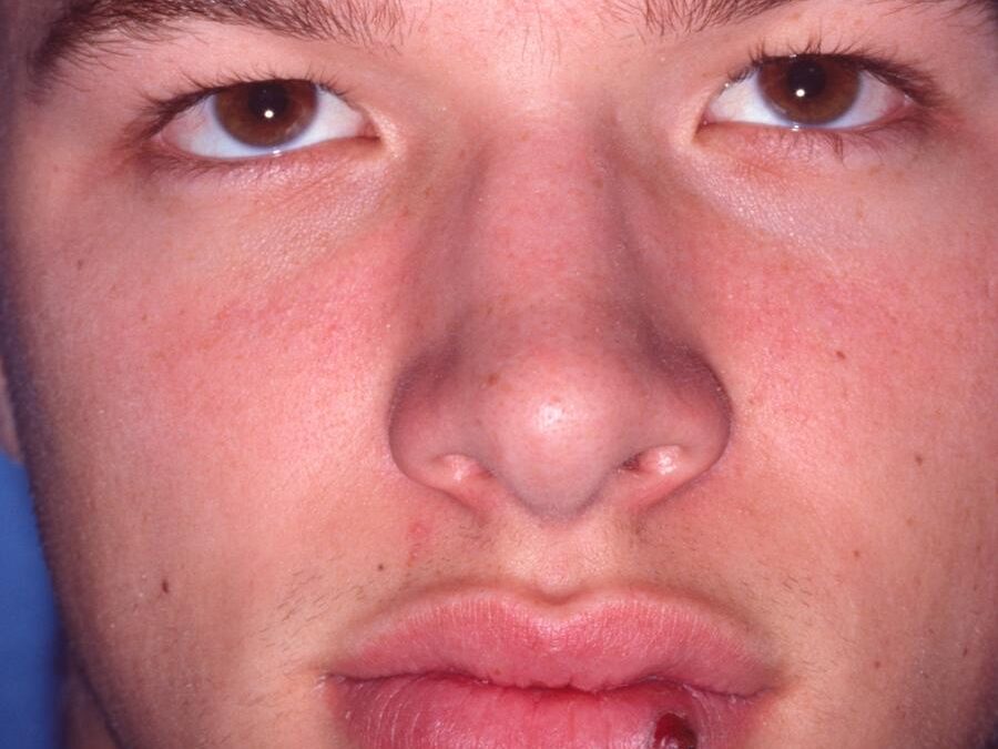 Pyogenic Granuloma:  Lobular Capillary Hemangioma…