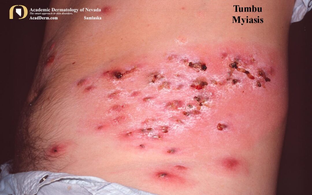 Tumbu Myiasis:  Cordylobia Anthropophaga…