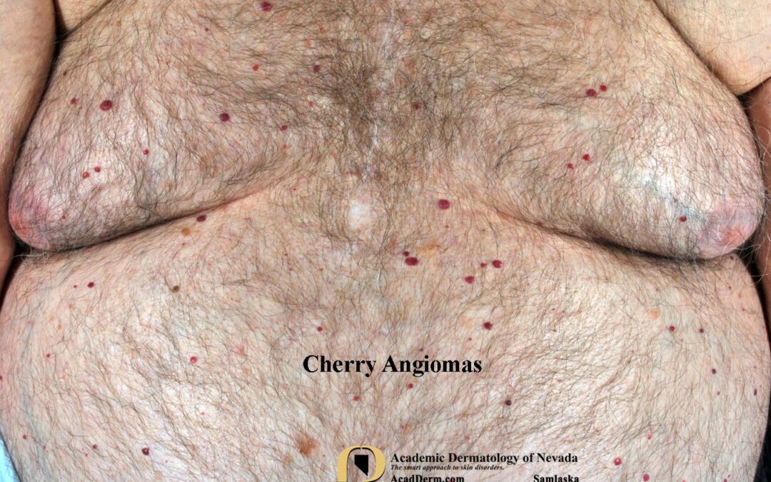 Cherry Angioma:  Senile Angioma…
