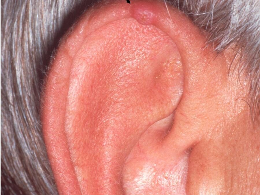 Chondrodermatitis:  Chondrodermatitis Nodularis Helicis…