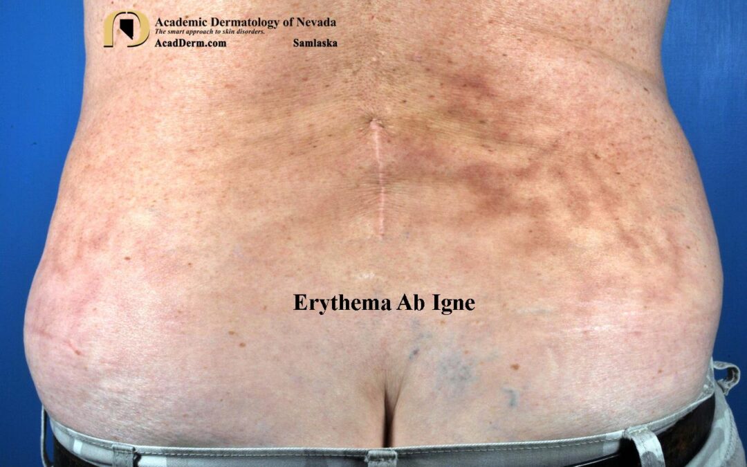 Erythema Ab Igne:  Stop Using The Heating Pad…