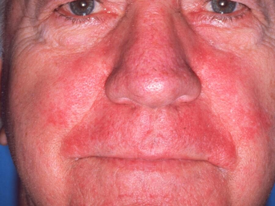 Seborrheic Dermatitis:  Dandruff, Cradle Cap…