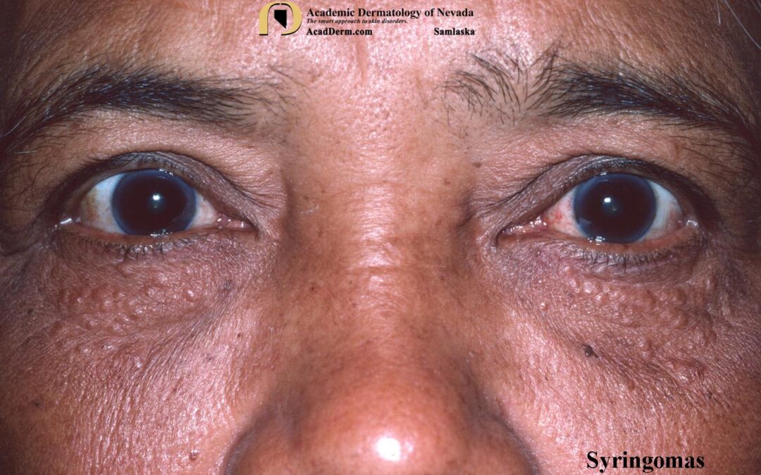 Syringoma:  Tadpoles in the skin…