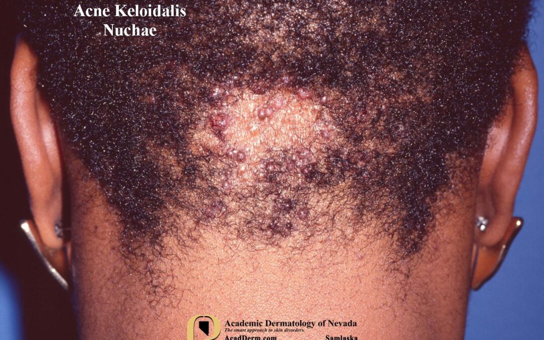 Acne Keloidalis Nuchae (AKN):  Folliculitis Keloidalis…
