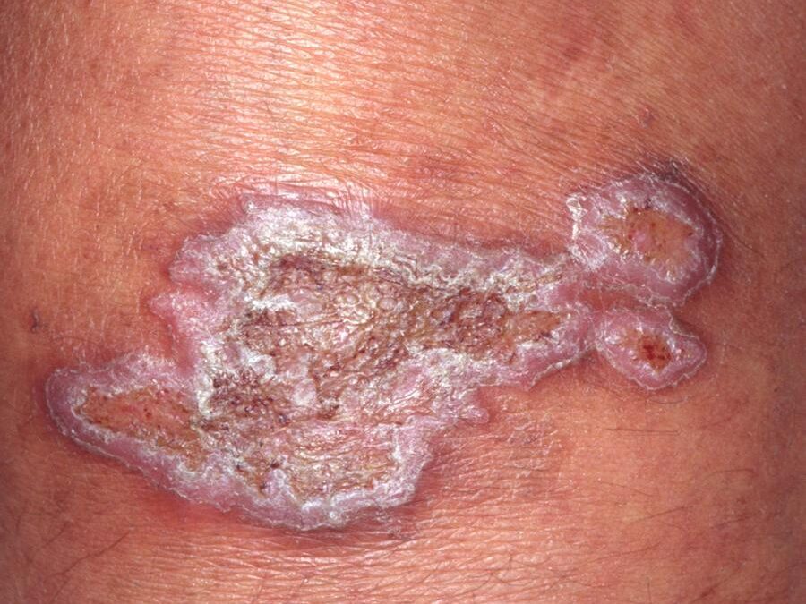 Chromoblastomycosis (CBM):  Chromomycosis…
