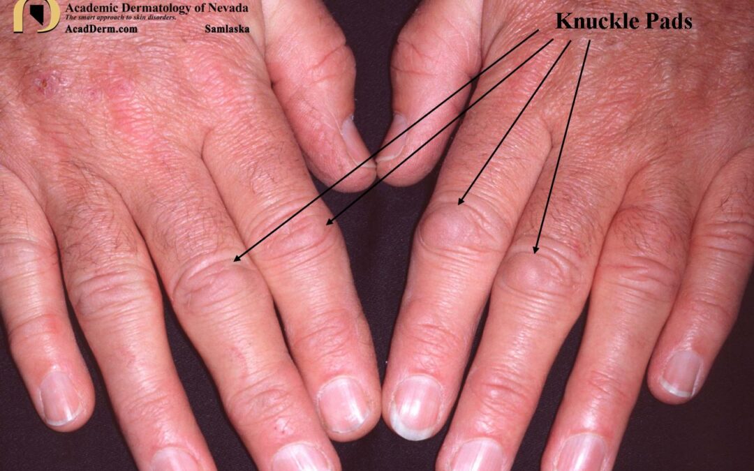 Knuckle Pads:  Heloderma…