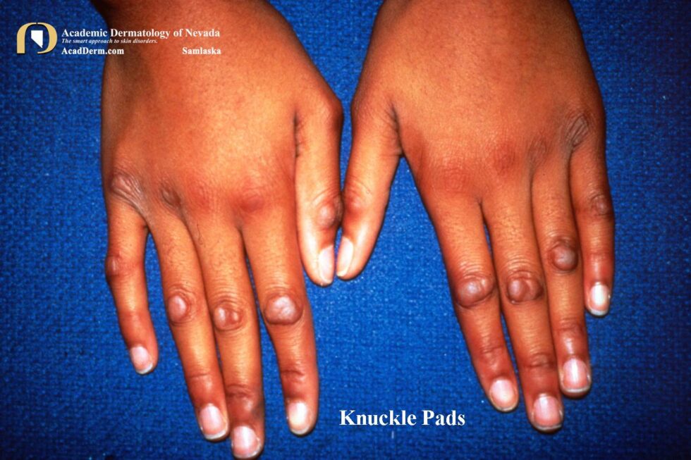 Knuckle Pads: Heloderma… - Academic Dermatology of Nevada
