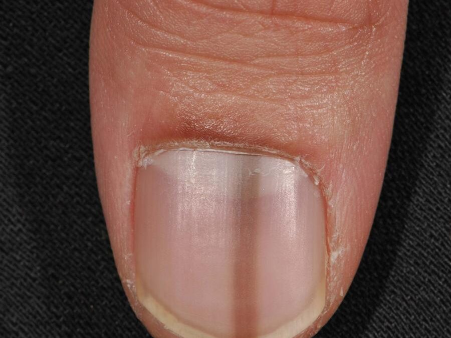 Melanonychia Striata Longitudinalis (MSL):  Pigmented bands…