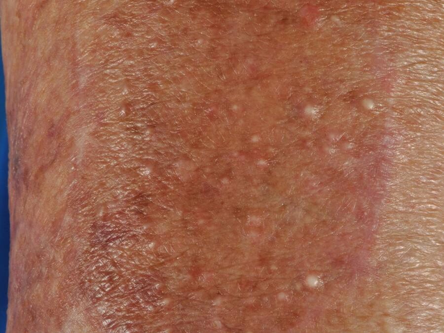 Milia:  Milium, Milia En Plaque…