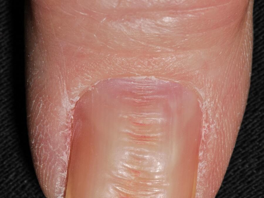 Nail Trauma:  Washboard Nails, Nail Biting…