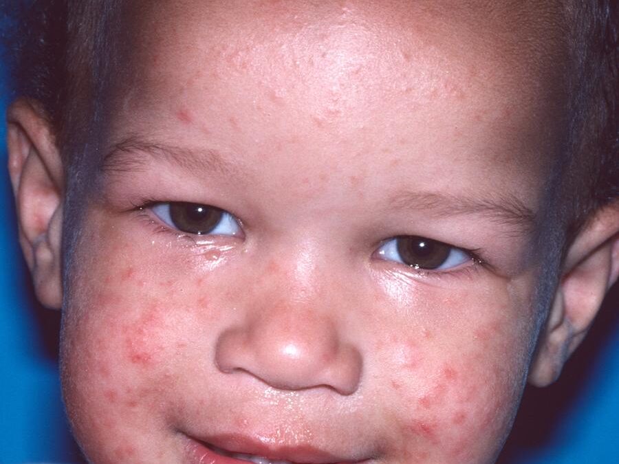 Gianotti-Crosti Syndrome:  Papular Acrodermatitis of Childhood…
