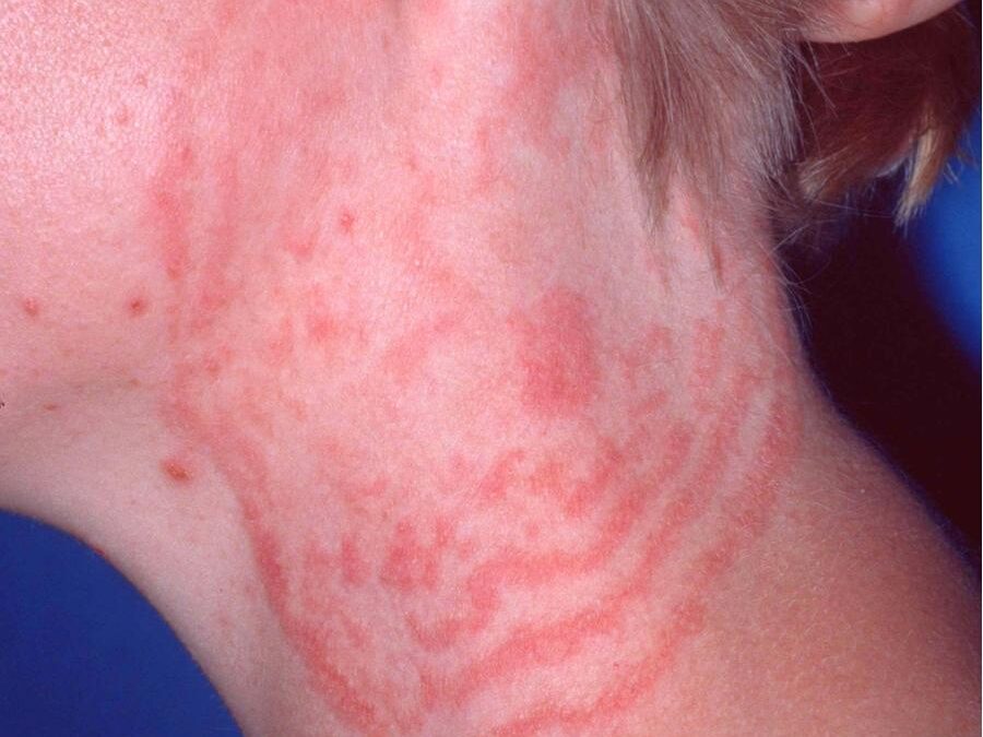 Tinea Corporis:  Ringworm, Tinea Circinata…