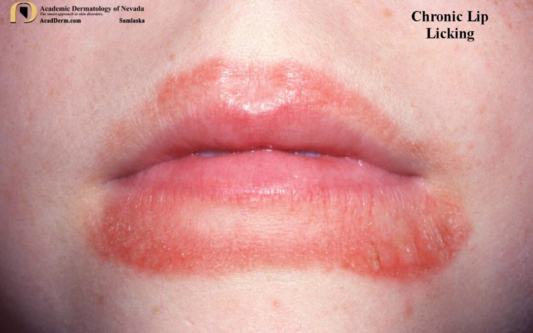 Chronic Lip Licking:  Exfoliative Cheilitis…