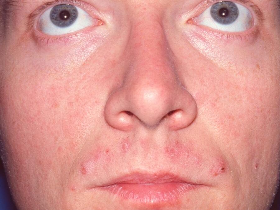 Impetigo:  Impetigo Contagiosa…
