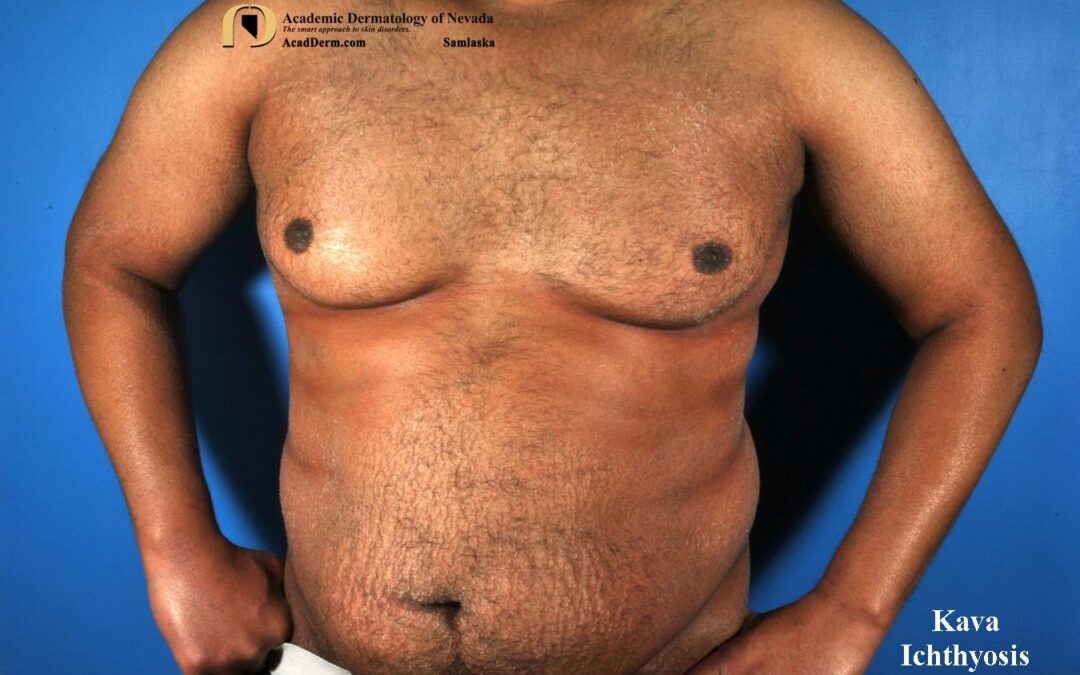 Kava Dermopathy:  Kava Ichthyosis, Crocodile Skin…