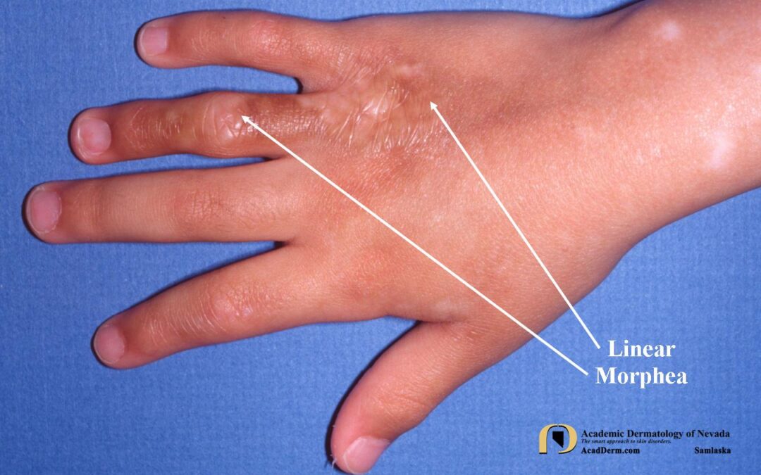 Linear Morphea:  Linear scleroderma…