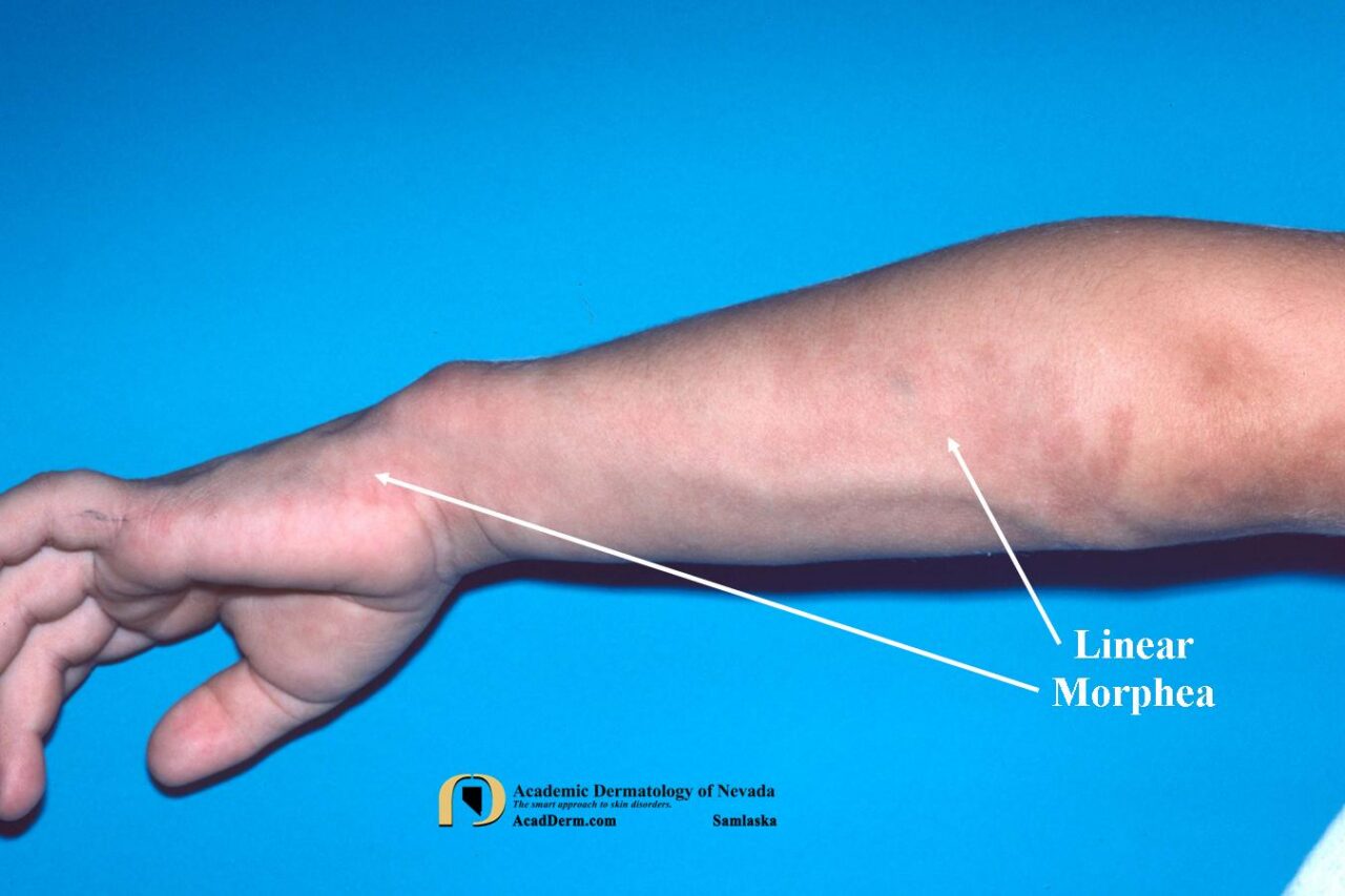 Linear Morphea: Linear scleroderma… - Academic Dermatology of Nevada