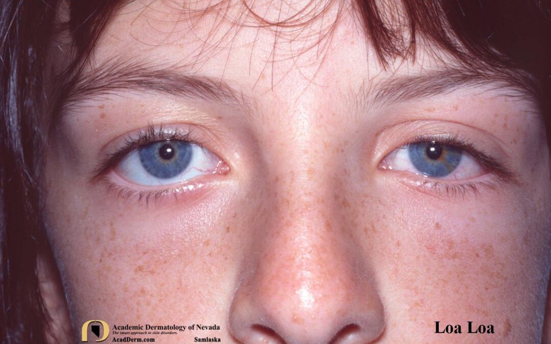 Loiasis:  Loa Loa, Tropical Swelling…