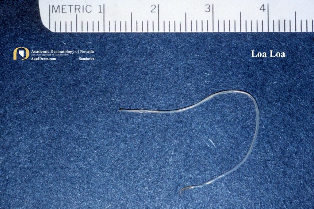 Python Swollen Loaa Loiasis: Loa Loa, Tropical Swelling… - Academic Dermatology of Nevada