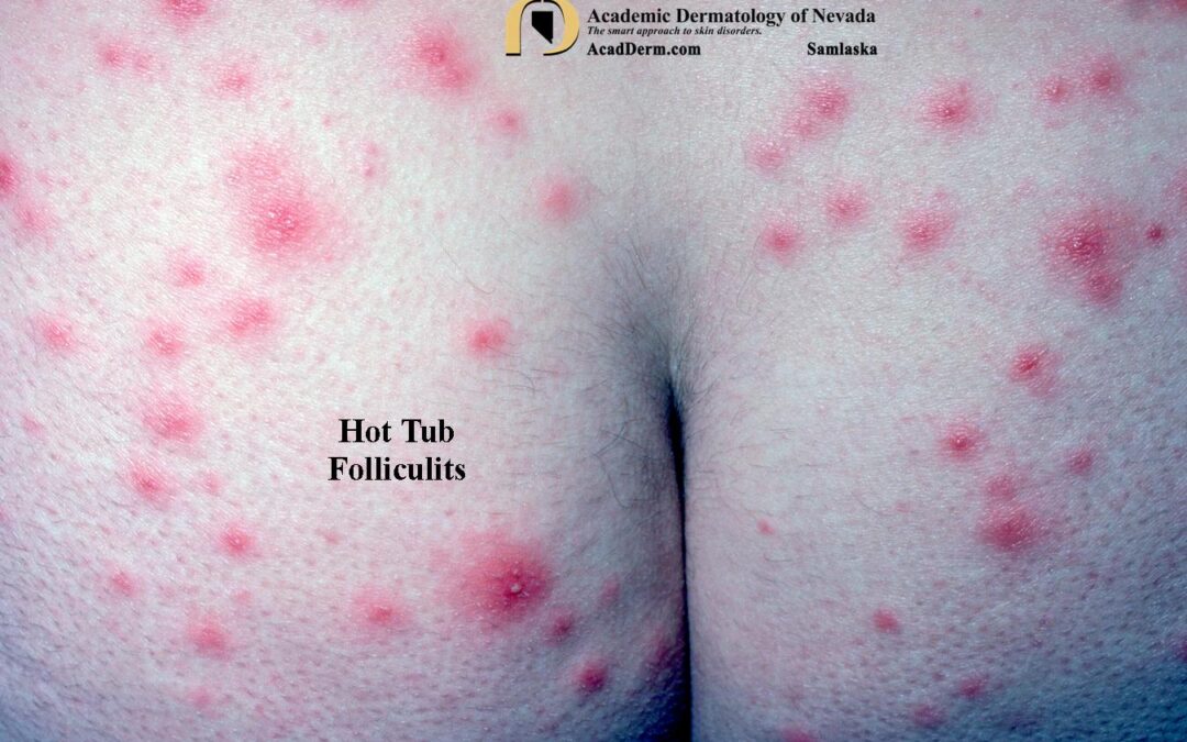 Hot Tub Folliculitis:  Spa Pool Folliculitis…