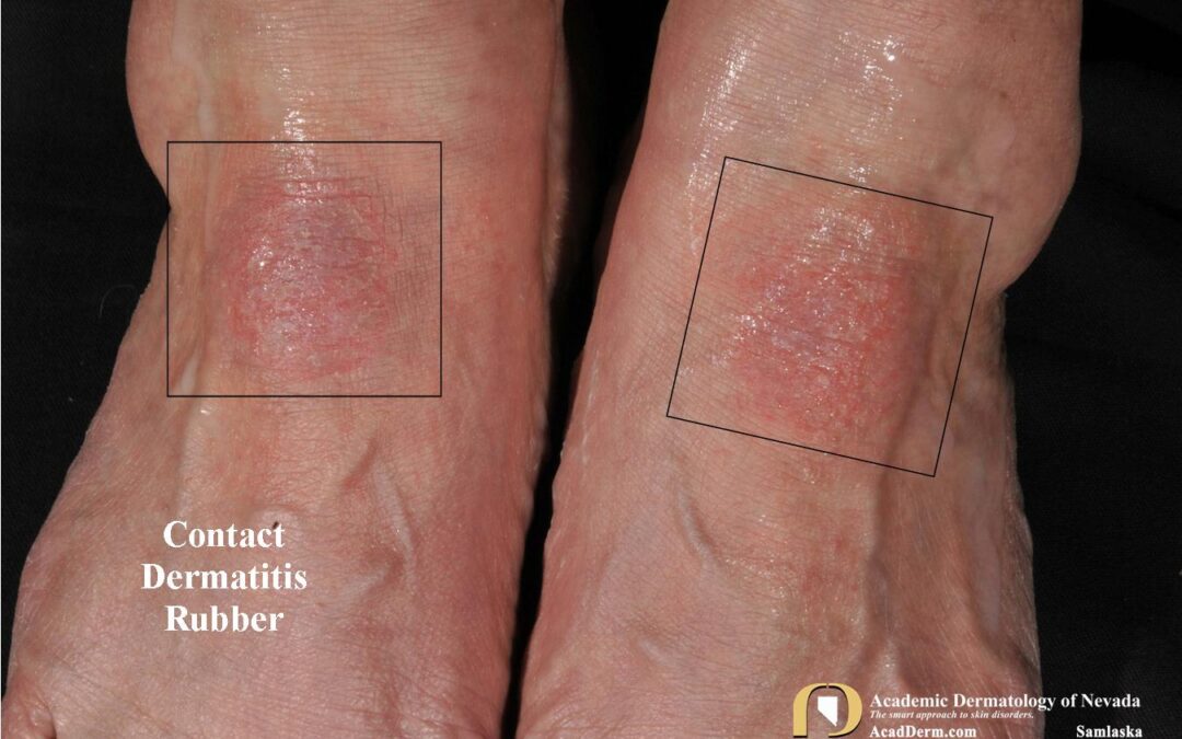 Contact Dermatitis:  Rubber…