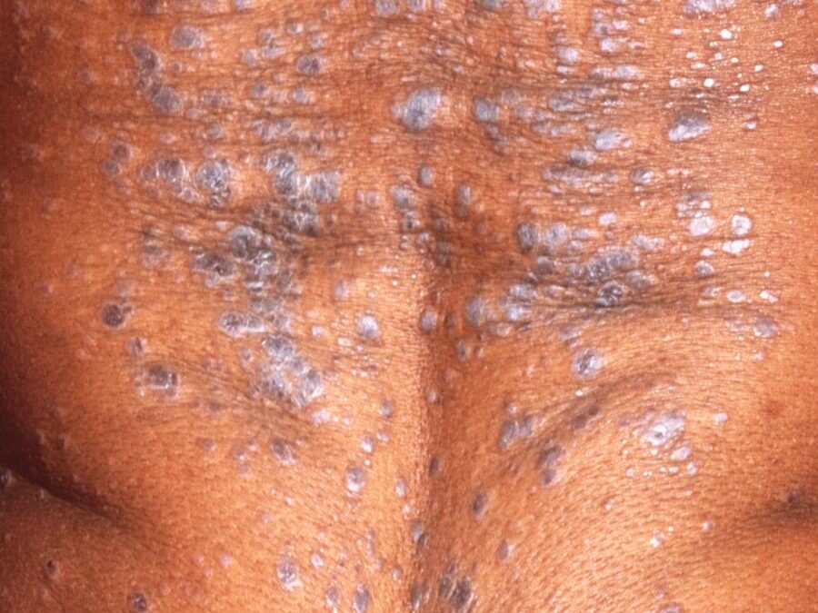 Lichen Planus:  Tree moss on a flat and even surface…