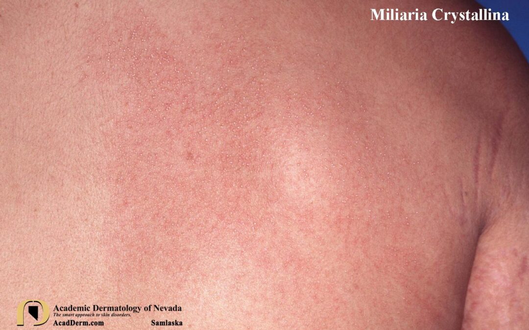 Miliaria Crystallina:  Sudamina…