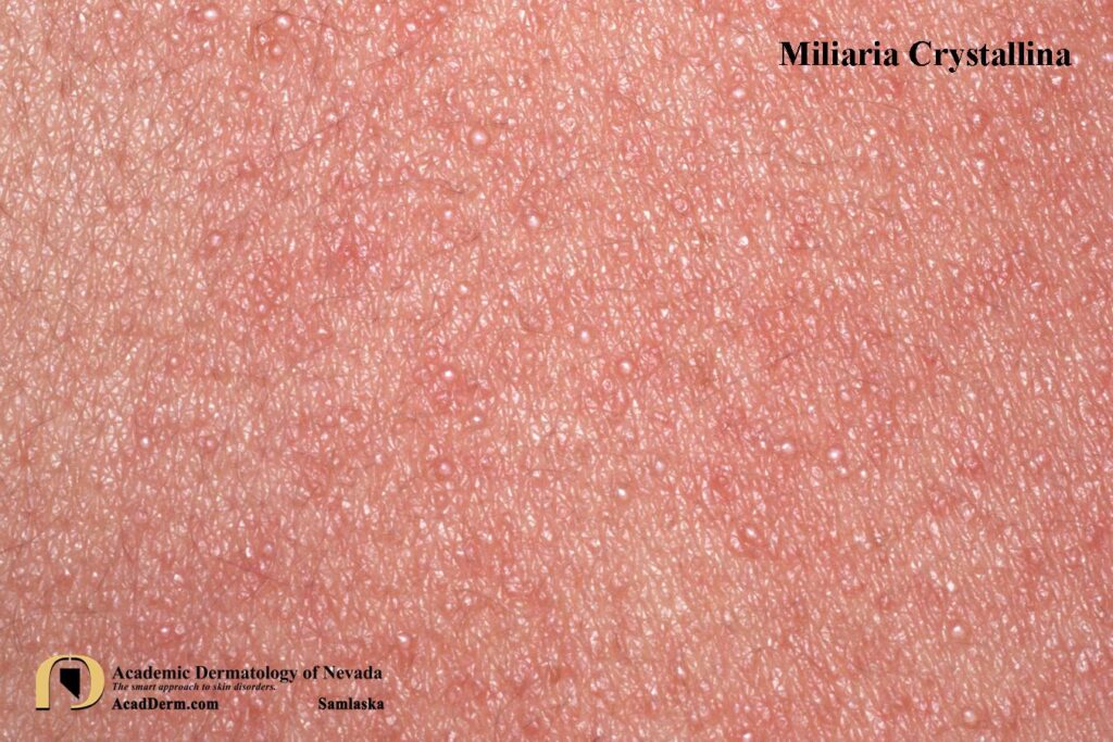 MiliariaCrystal2Samlaska - Academic Dermatology of Nevada