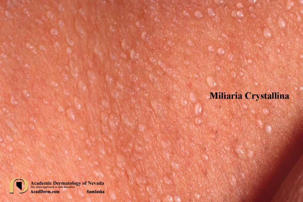 MiliariaCrystal3Samlaska - Academic Dermatology of Nevada