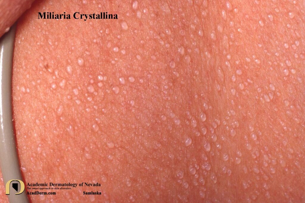 MiliariaCrystal4Samlaska - Academic Dermatology of Nevada