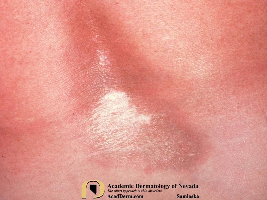 Lichen Sclerosus:  Lichen Sclerosus et Atrophicus, Kraurosis Vulvae, Balanitis Xerotica Obliterans…