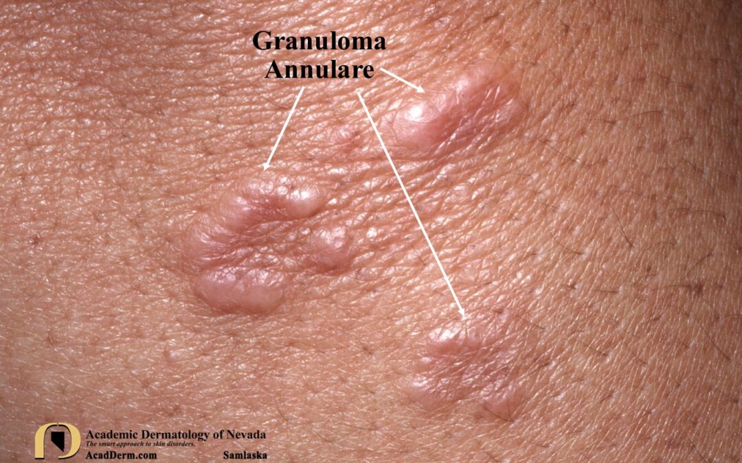 Granuloma Annulare:  Palisaded Granulomatous Dermatoses…