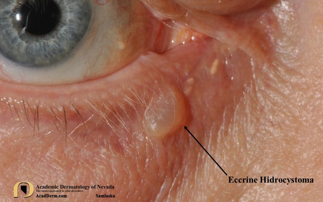 Eccrine Hidrocystomas:  Dilated Sweat Duct or Gland…
