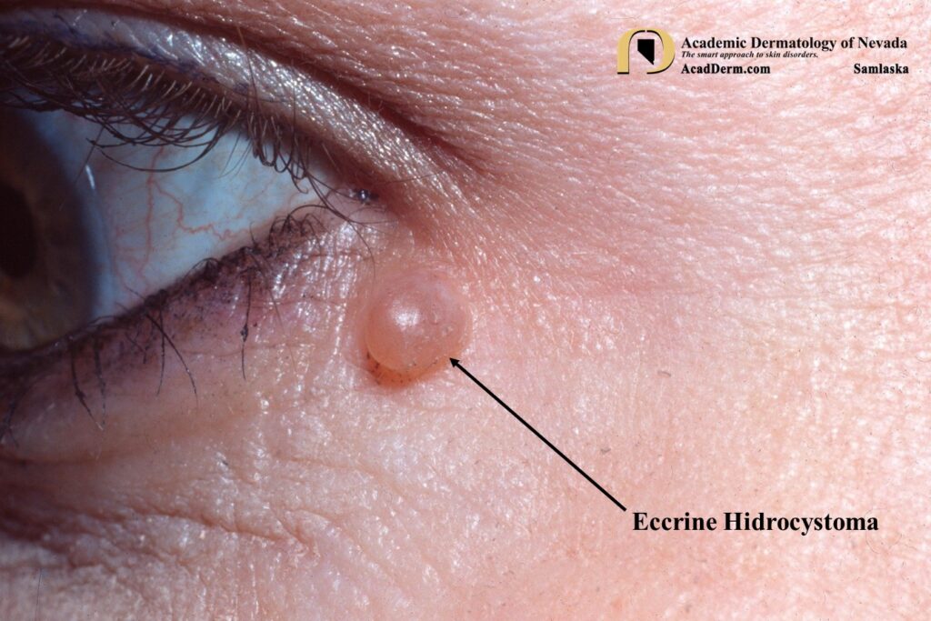 EH2Samlaska - Academic Dermatology of Nevada
