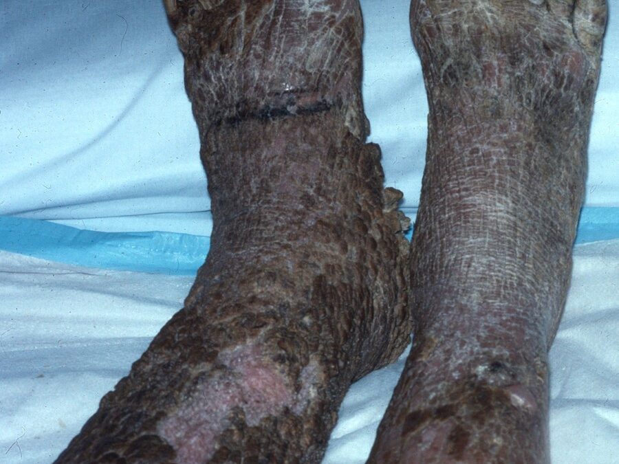 Elephantiasis Verrucosa Nostra: Mossy foot…
