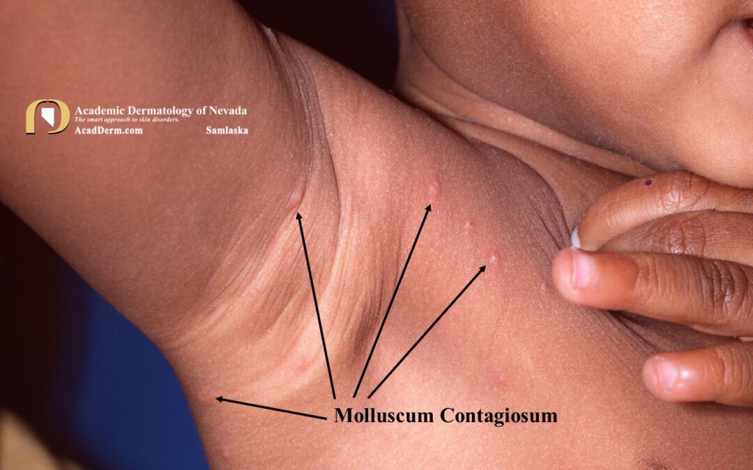 Molluscum Contagiosum:  Water Warts…