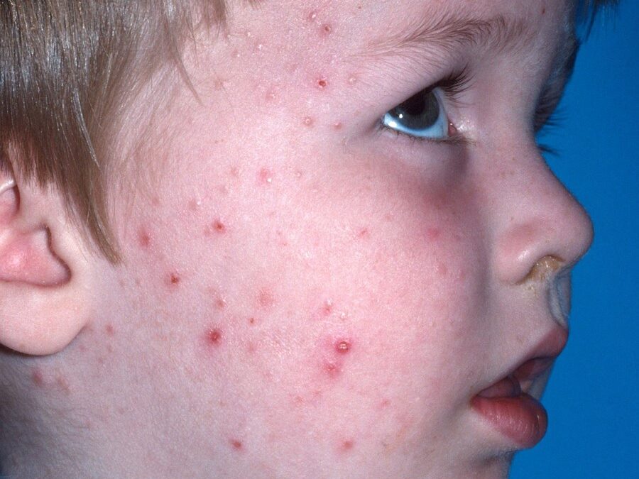 PLEVA:  Pityriasis Lichenoides et Varioliformis Acuta…