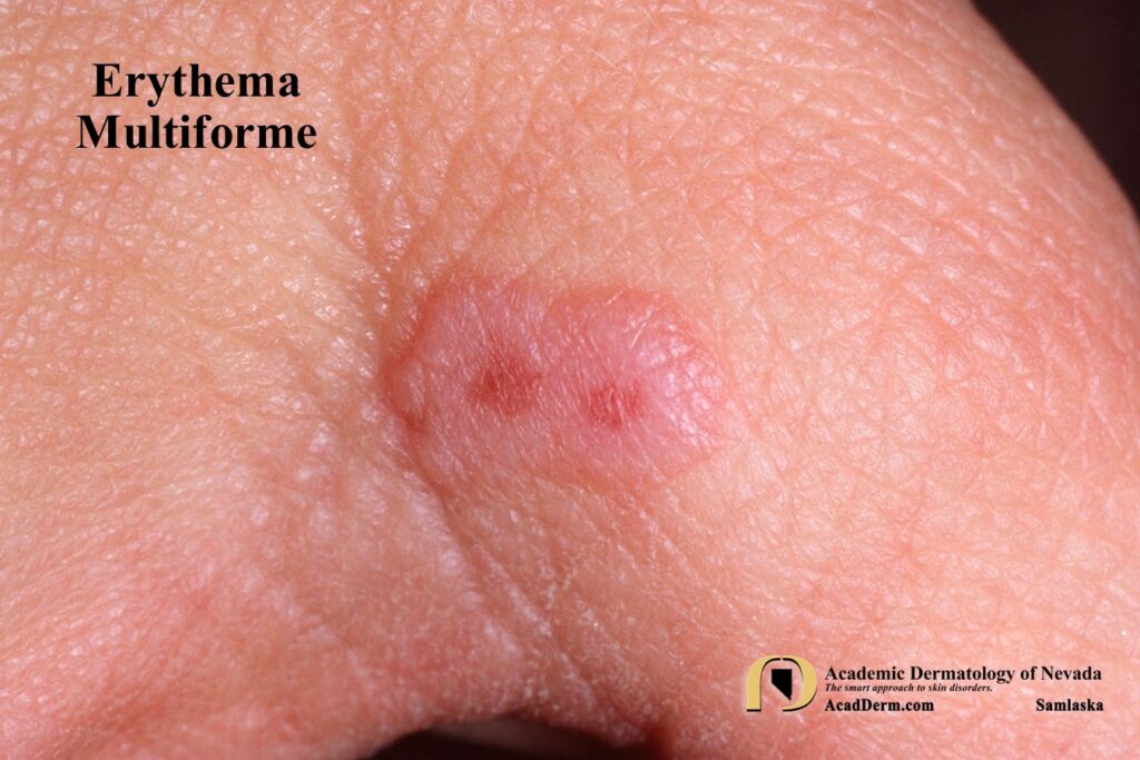 EM1Samlaska - Academic Dermatology of Nevada