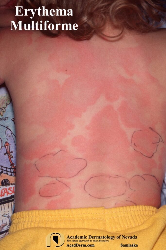 EM7Samlaska - Academic Dermatology of Nevada