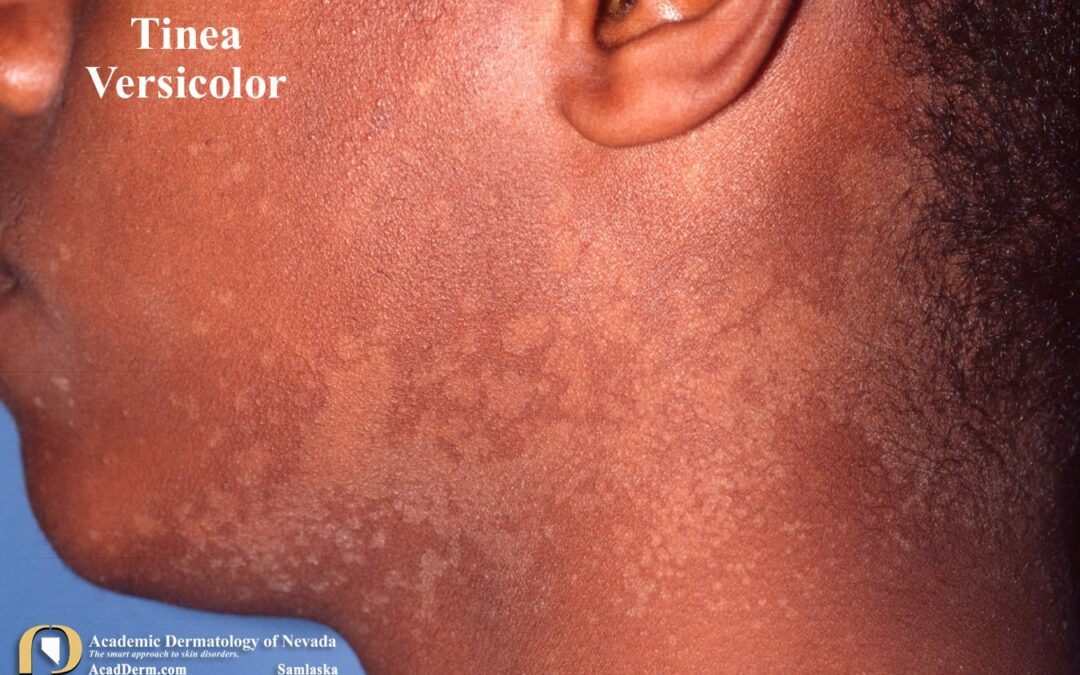 Tinea Versicolor:  Pityriasis Versicolor…