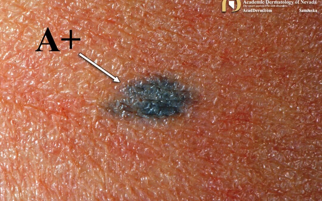 Atomic Tattoo:  Blood-type tattoos during the Cold War…
