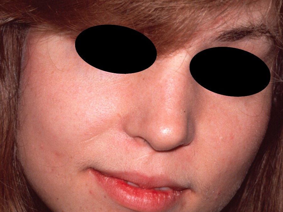 Lafora’s Disease:  Progressive Myoclonus Epilepsy…