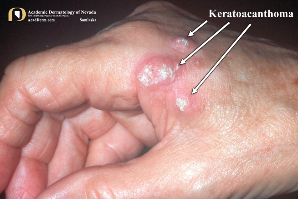 KA1Samlaska - Academic Dermatology of Nevada